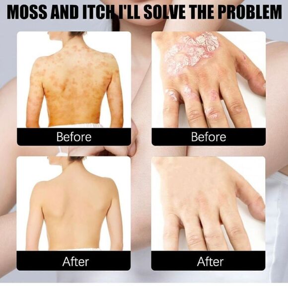 New Seborrheic Dermatitis Spray, Psoriasis Cream, Scalp Cream for Comfort and Re - Picture 5 of 7